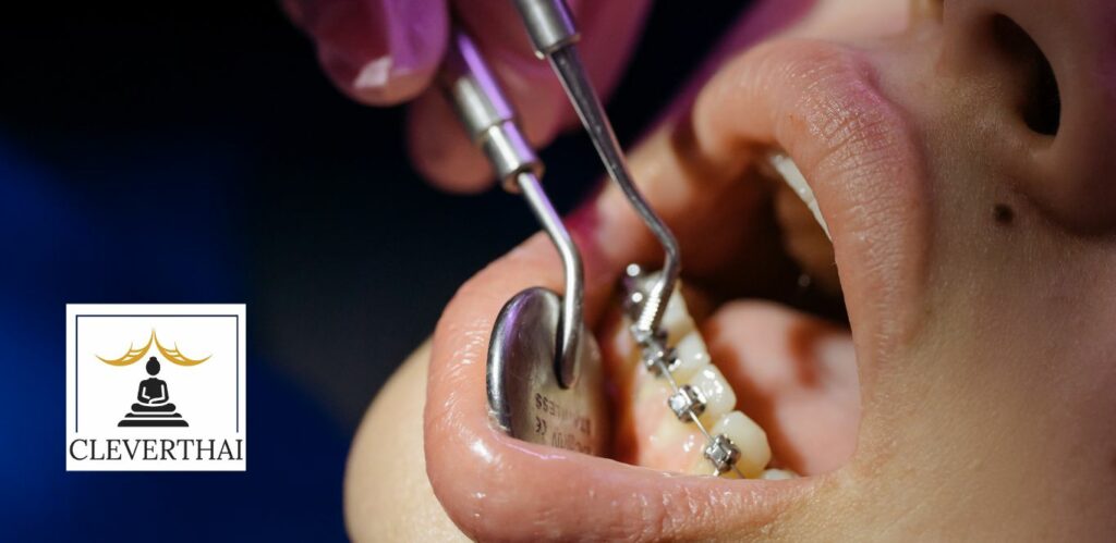 Top 7 Dental Clinics for Braces in Bangkok
